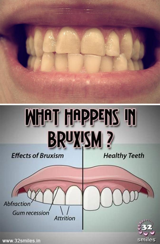 what-happens-in-bruxism